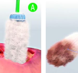 Alternative view of Que Gạc Làm Sạch Vết Thương Sâu - Debrisoft® Lolly